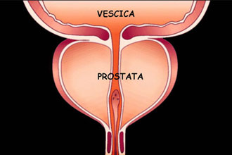 tumore della prostata