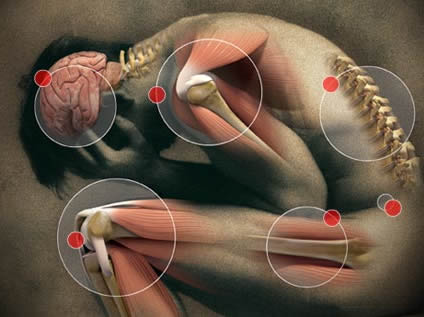 fibromialgia 